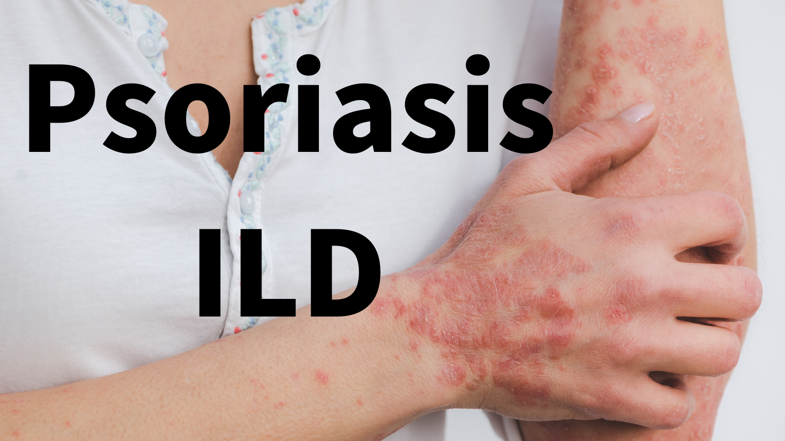 生物学的製剤使用中の乾癬と間質性肺炎の合併率 呼吸器内科専門医の間質性肺炎ブログ